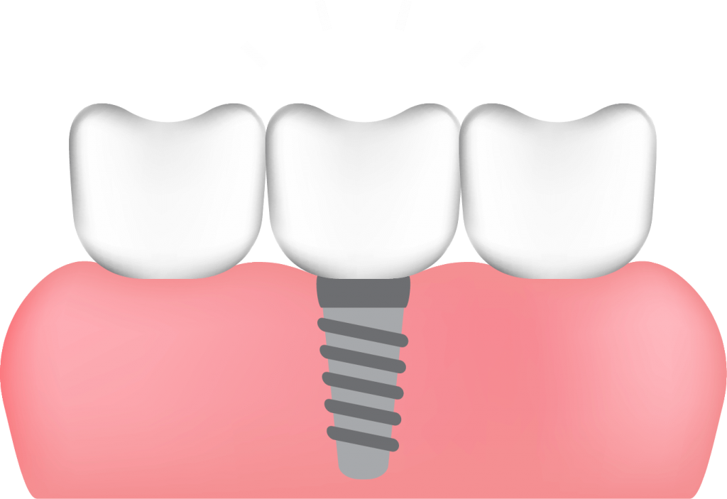 dental implant - clip india