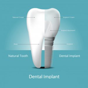 dental implants vs natural teeth - dental implants india