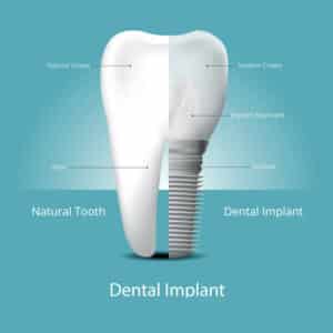 dental implants vs natural teeth - dental implants india