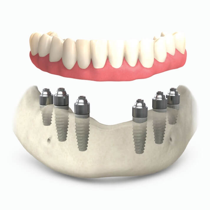 all on 6 six dental implants replace roots