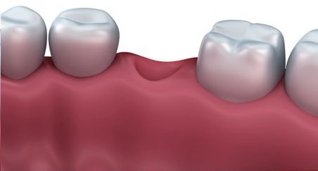 After Ridge Augmentation - Replace Roots, Dental implants Vadodara, Surat, Rajkot, Ahmedabad, best Quality Dental implants India