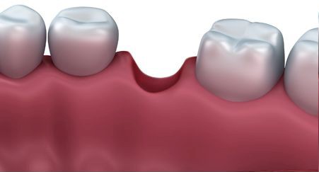 Before Ridge Augmentation - Replace Roots, Dental implants Vadodara, Surat, Rajkot, Ahmedabad, best Quality Dental implants India