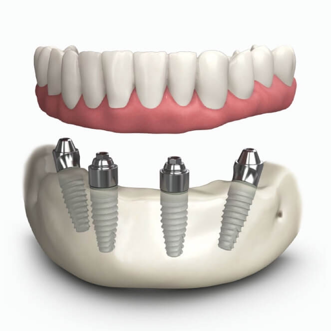 all on 4 dental implants replace roots india