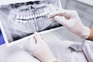 dental implants best choice
