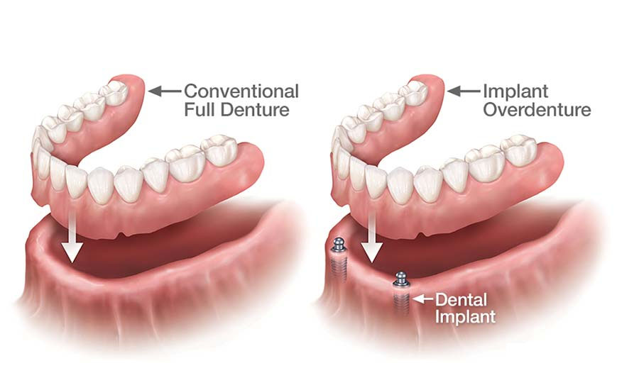 dental implant vs denture.difference