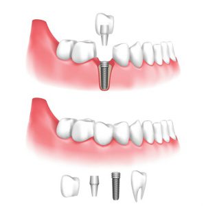 Types of Dental implants