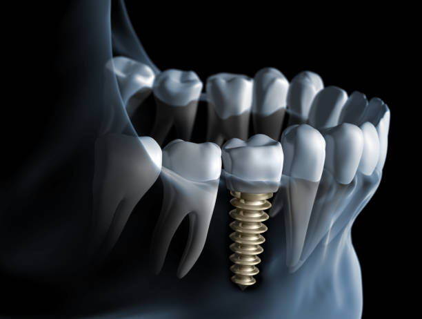 Revolutionary Advancements in Dental Implants: A Comprehensive Update